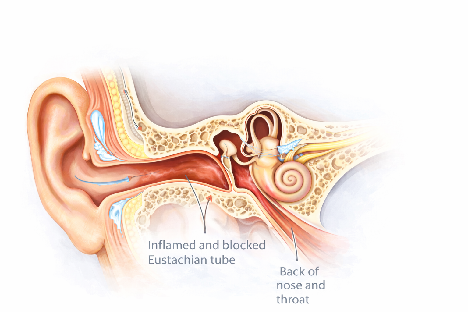 Eustachian tube dysfunction cross-section Eustachian tube dysfunction cross-section
